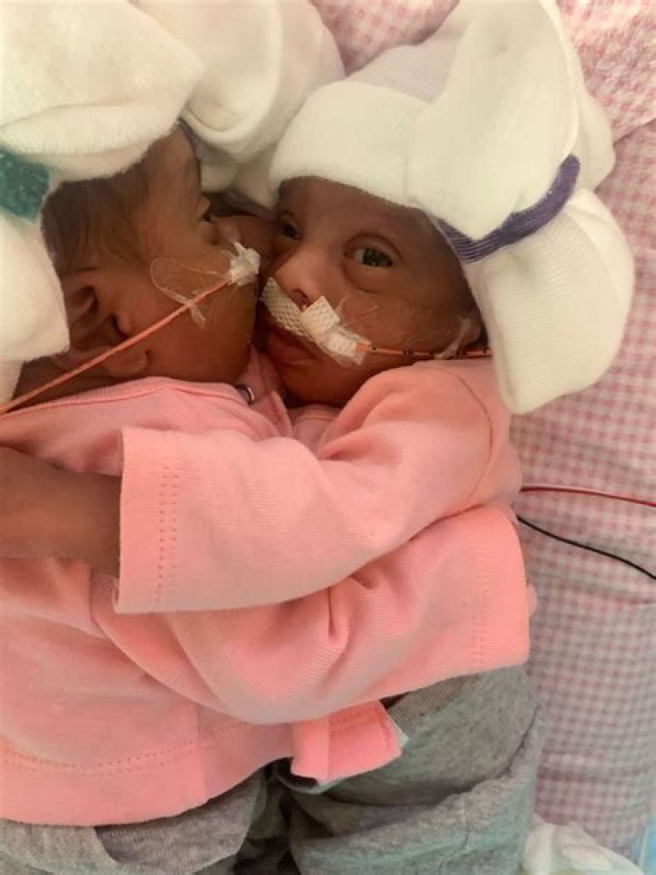 Amanda Arciniega And James Finley’s Conjointed Twins Separated, Meet JamieLynn and AmieLynn