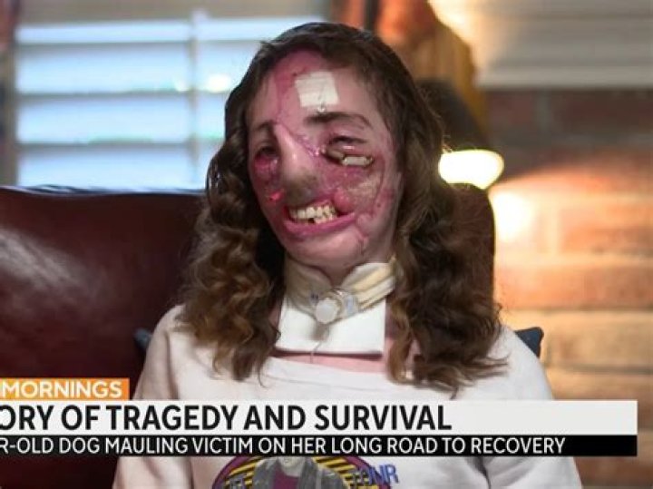 Jacqueline Durand Face Injuries After Texas Dog Walker Mauled